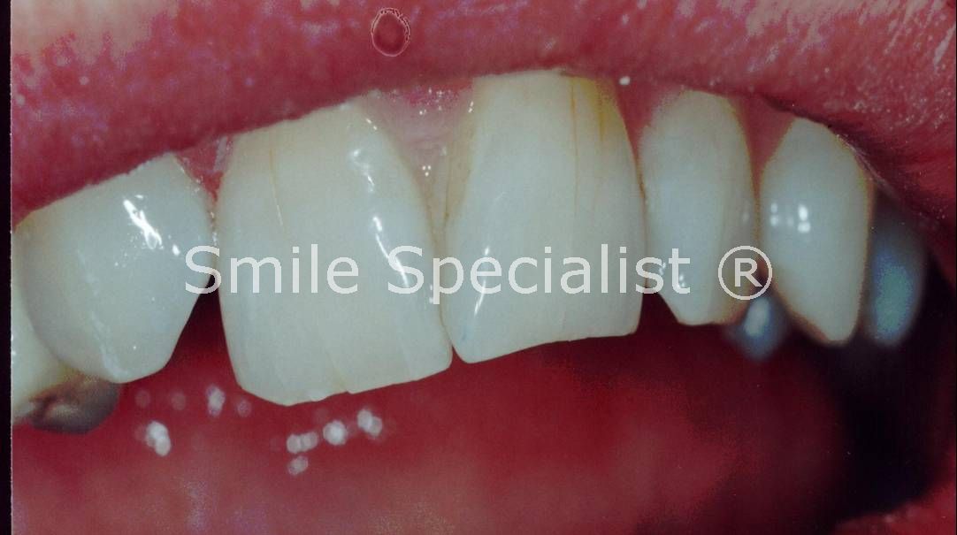 Before cosmetic Bonding