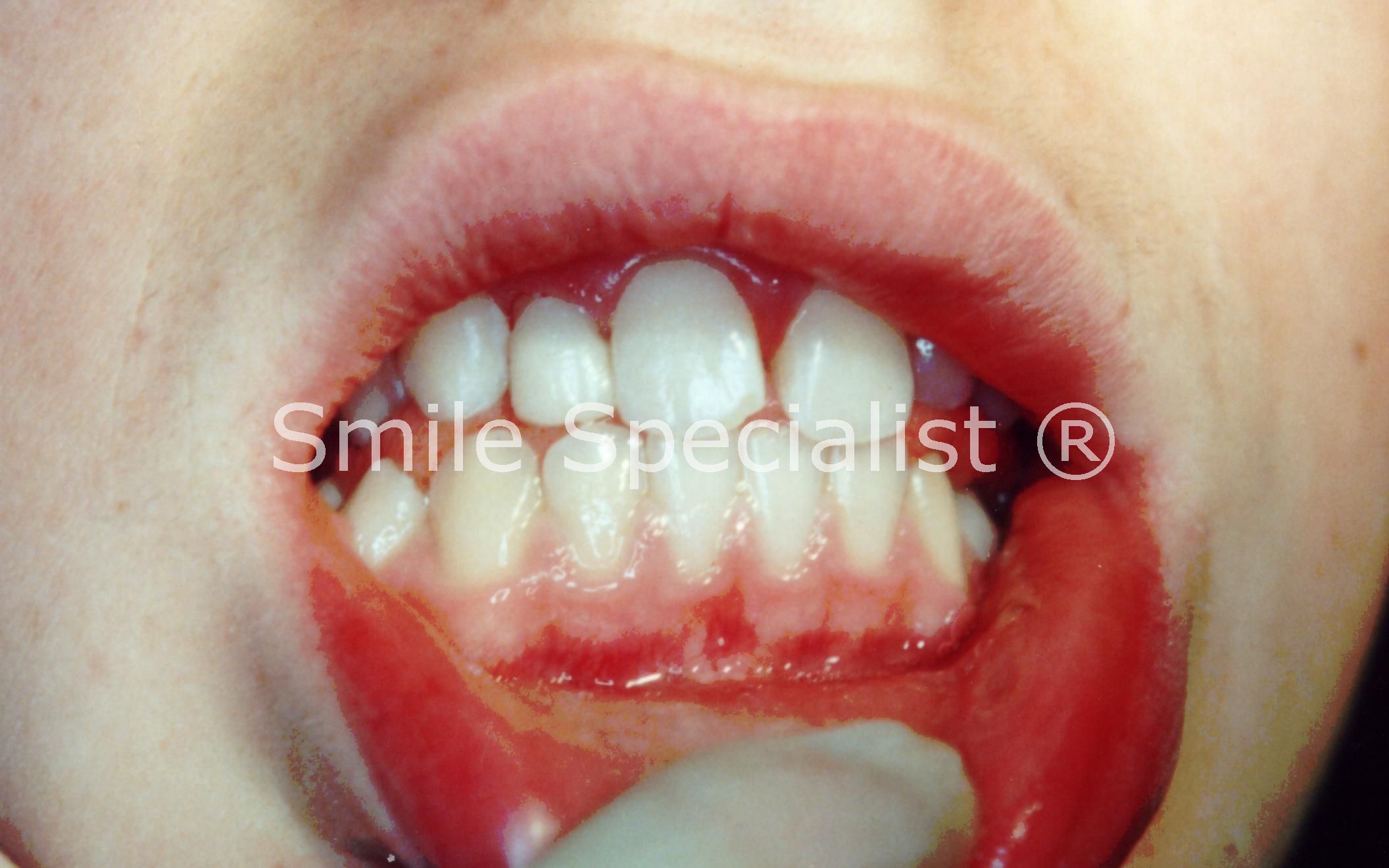 After cosmetic Bonding