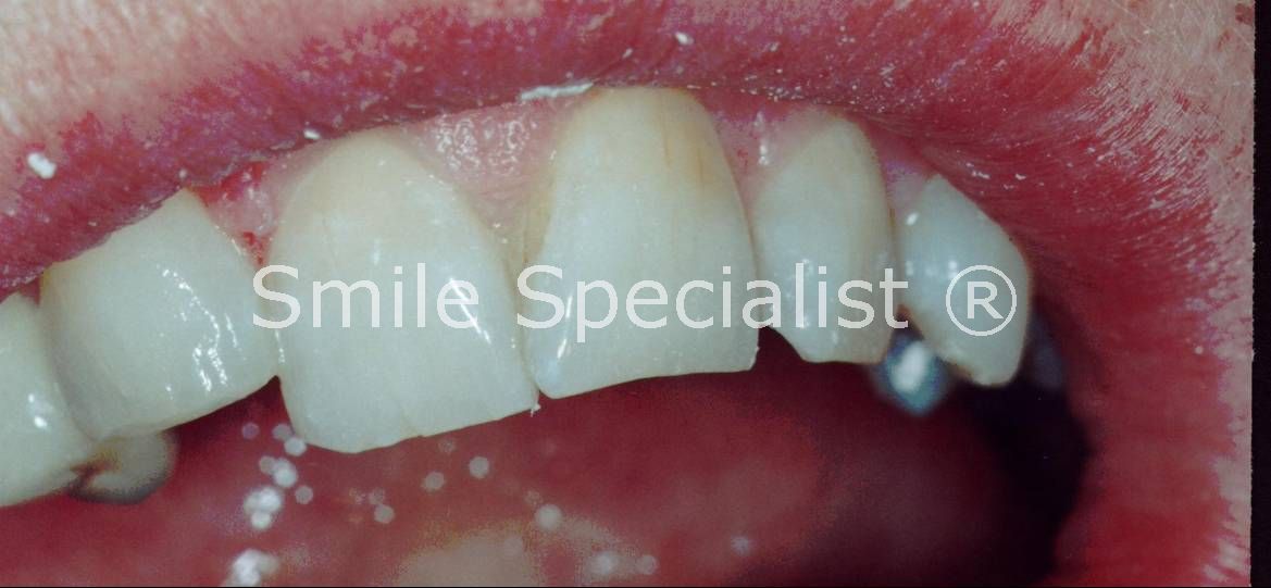 After cosmetic Bonding