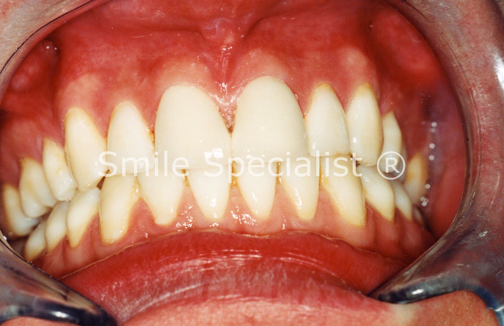 SmileSpecialist Cosmetic Crowns fitted to look Nice and Natural SmileSpecialist Cosmetic Crowns fitted to look Nice and Natural