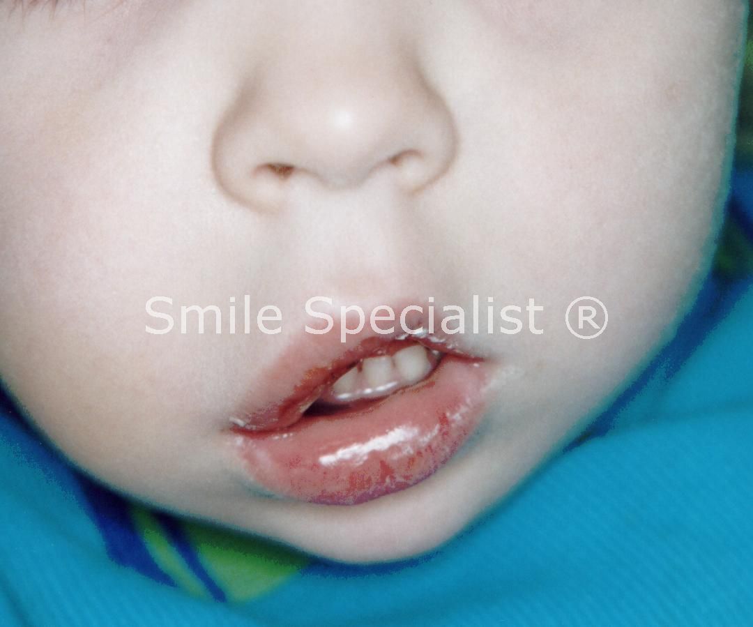 Facial swelling from dental infection