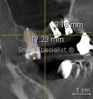 Smile Specialist Centre's Implants in reduced bone