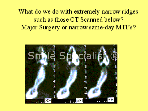 Mini-implant narrow bone example