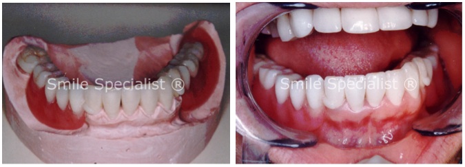 Ceramic Crowns + Denture and Clasps by Dr.Kilcoyne